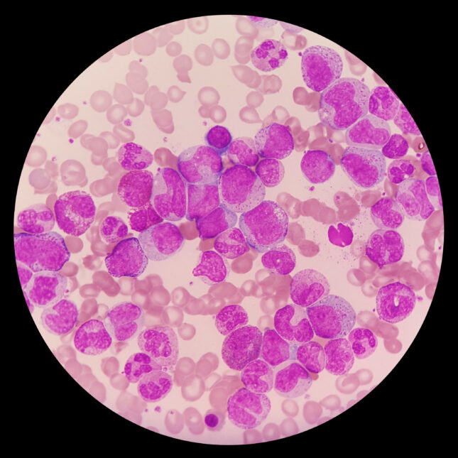 Chronic myeloid leukemia -- Cancer coverage from STAT