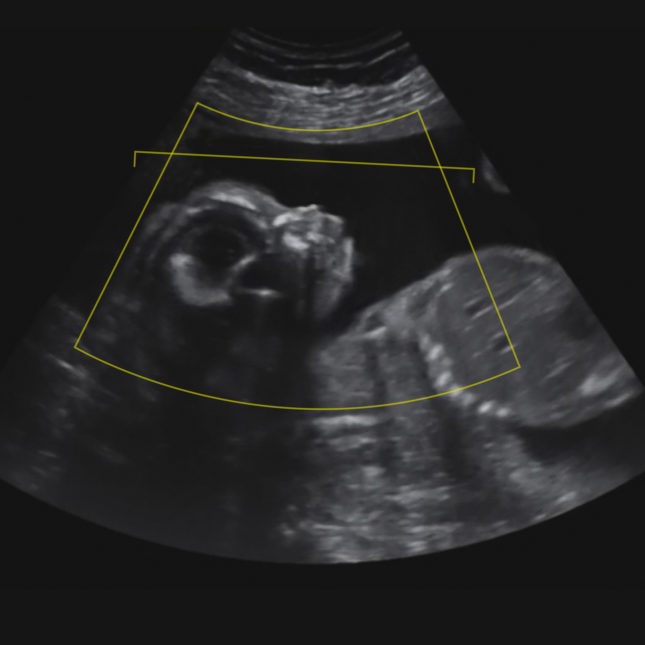 Fetal ultrasound